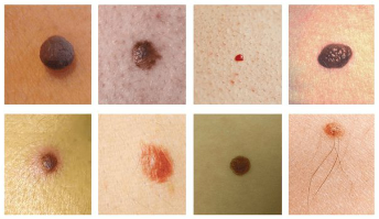 The most common spot on the skin is moles and papillomas (warts)