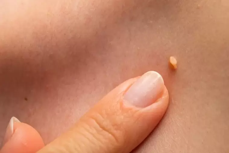 Papilloma in the skin
