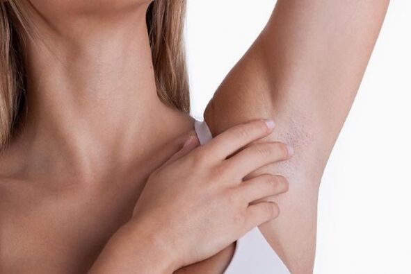 papillomas under a woman's armpits