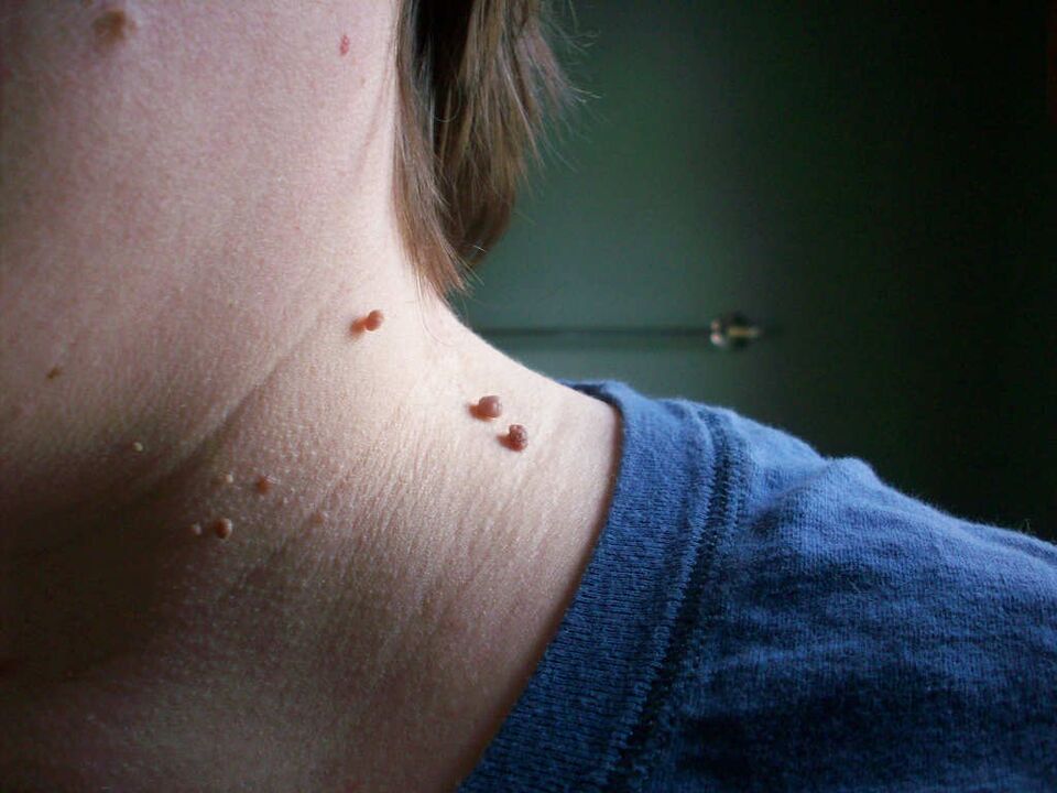 neck papillomas how to treat