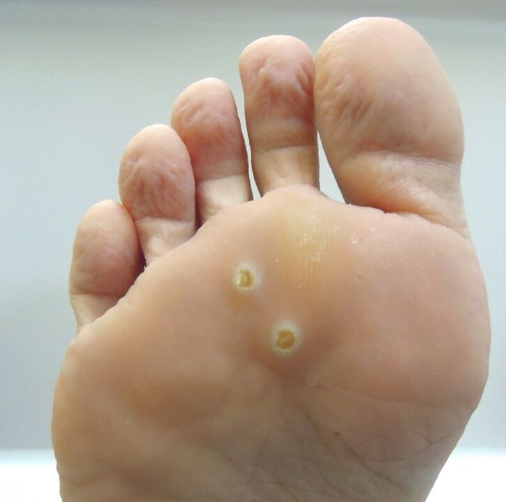 how to remove wart on foot