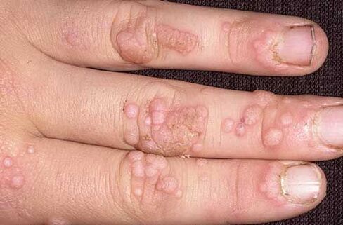 how to remove warts on hands