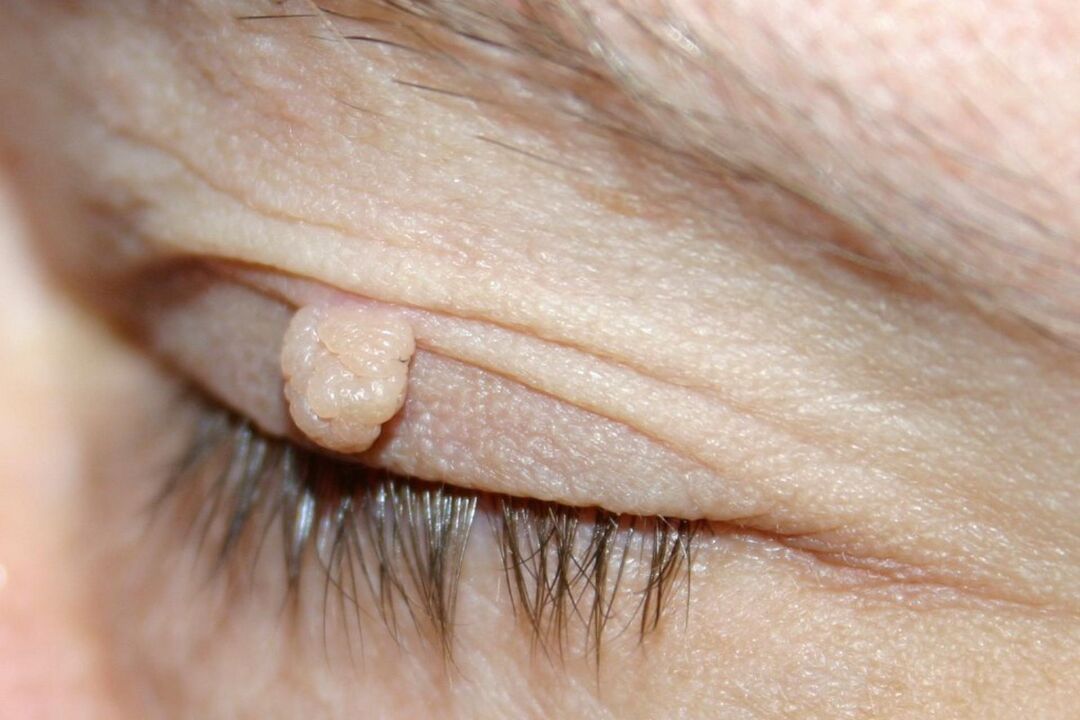 eyelid papilloma symptoms