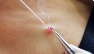 removal of papillomas in the body with a laser