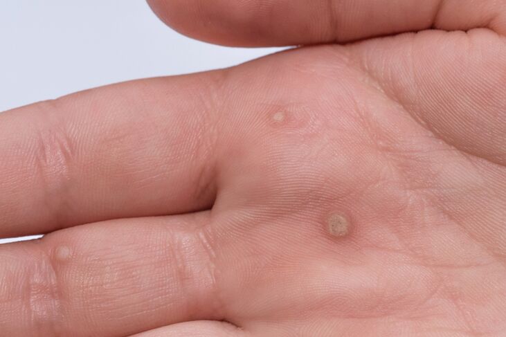 Flat warts on the palm of the hand